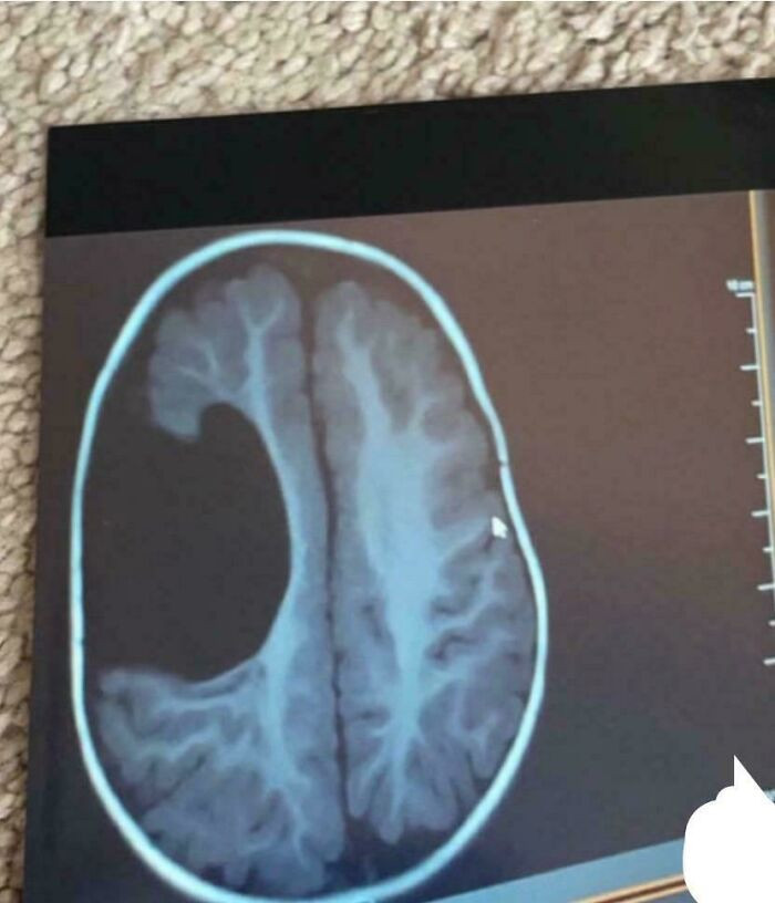 "MRI Photo Of My Brain Yes This Is Real"