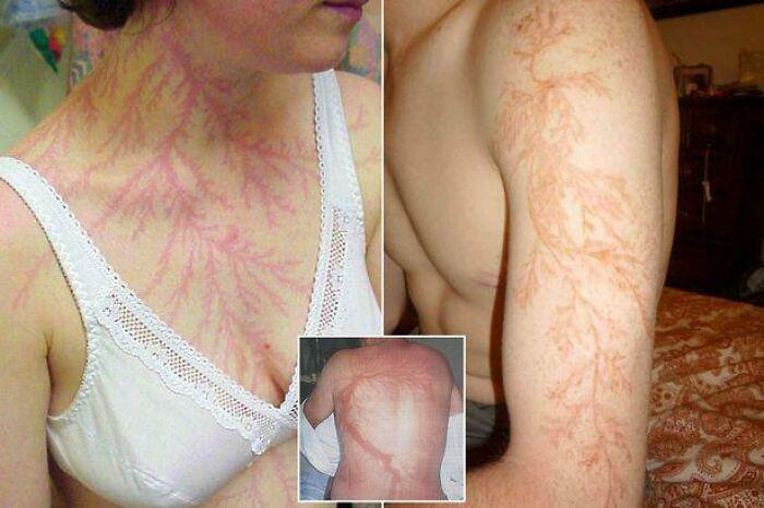 "The Scars On The Bodies Of Those Who Survived A Lightning Strike"