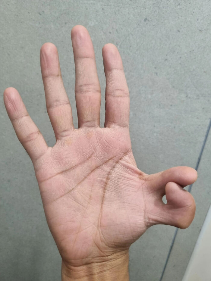 "Have 6 Fingers (On Both Hands)"