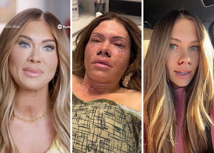 Jessi Ngatikaura - Nostril width reduction