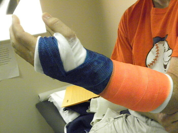 17. Broken arm with a cast