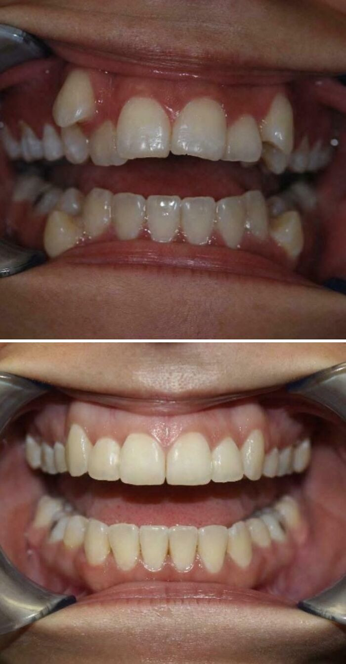 "My Teeth, Before And After Braces"
