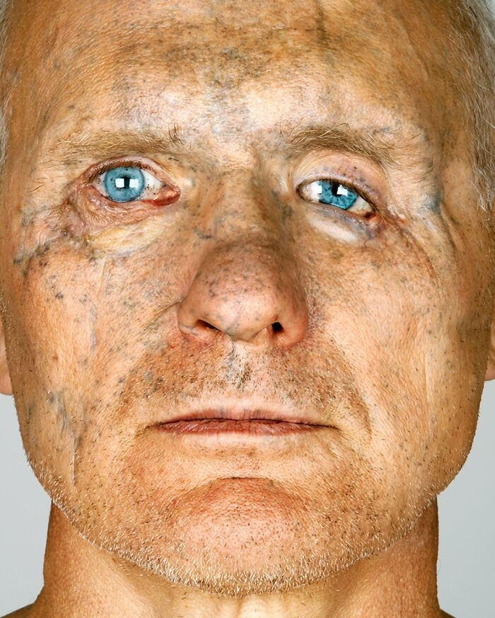 Teresa portrait with alopecia, The Power of Vulnerability theme emphasized.