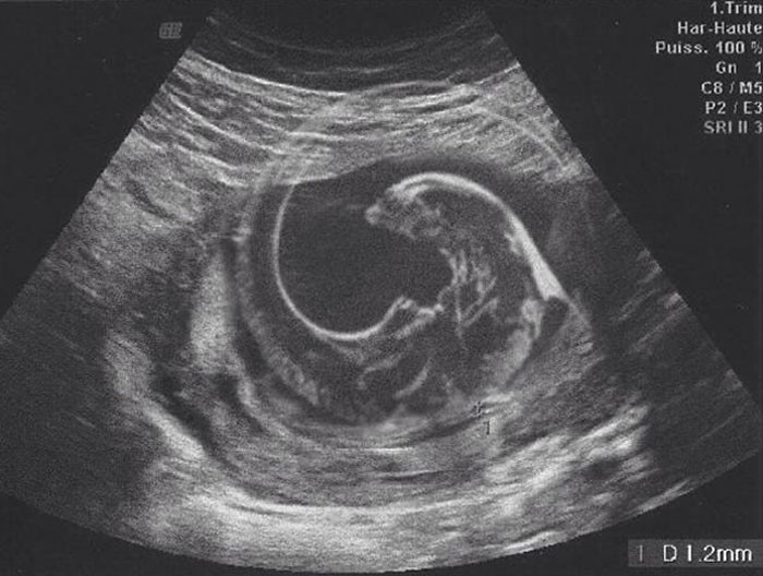 22. This morphed ultrasound image of their first baby. The wife wasn't impressed.