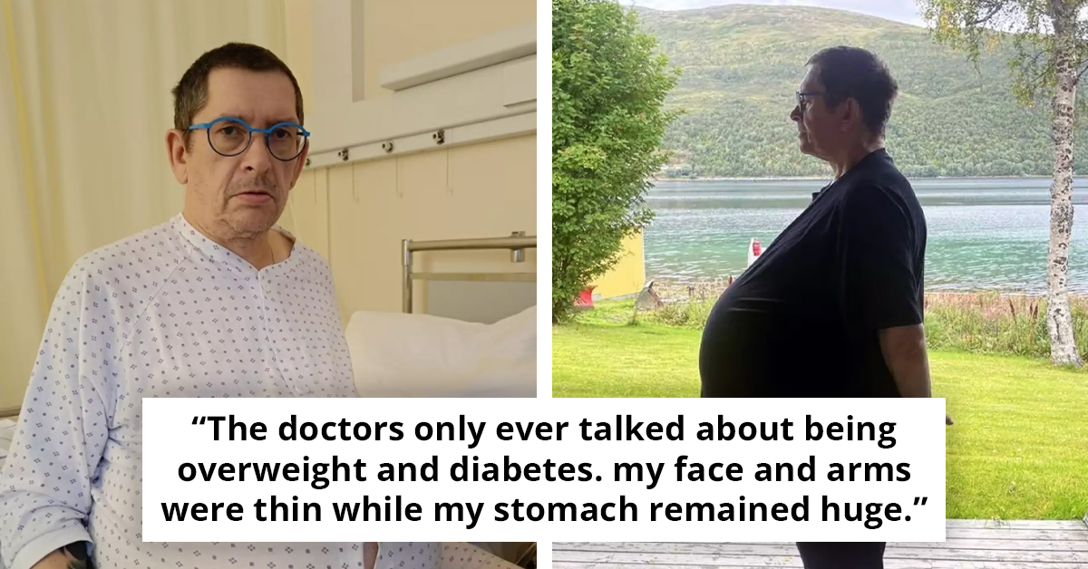 Man’s 60-Pound Tumor Misdiagnosed as Obesity Sparks Outrage—The Shocking Truth Behind His 12-Year Battle