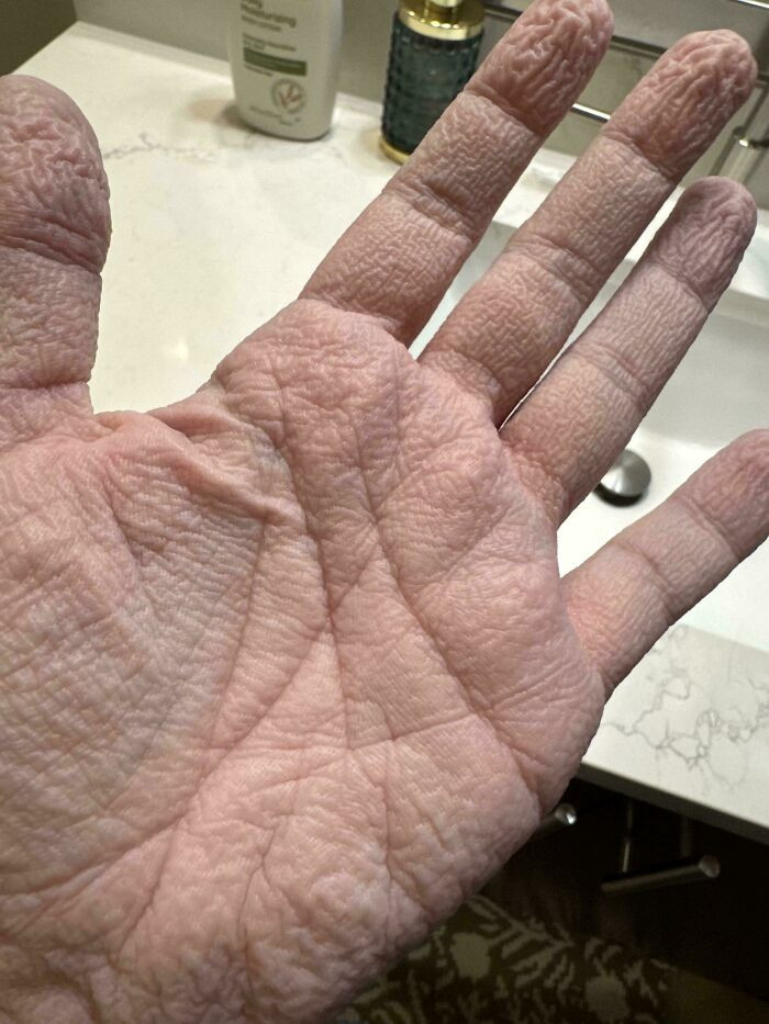 "My (25f) Palms After A Normal 10-Minute Shower"