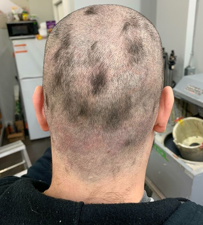 "My First Attempt At 'Shaving' My Head. I've Been At Work For Two Days Like This And Didn't Even Realize Until A Coworker Asked, 'Are You Okay?'"