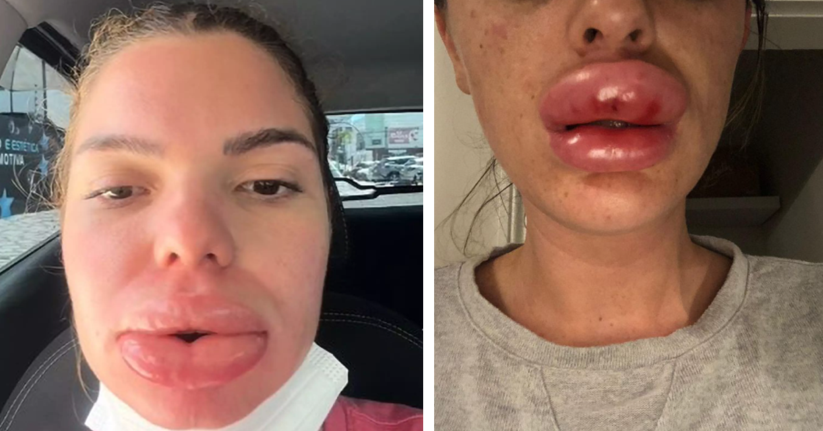 Woman Suffers Agony As Blood Supply To Mouth Cut Off After 'Routine' Lip Filler Operation