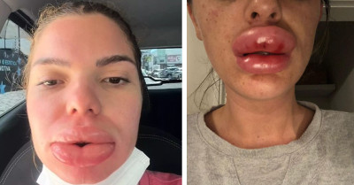 Woman Suffers Agony As Blood Supply To Mouth Cut Off After 'Routine' Lip Filler Operation