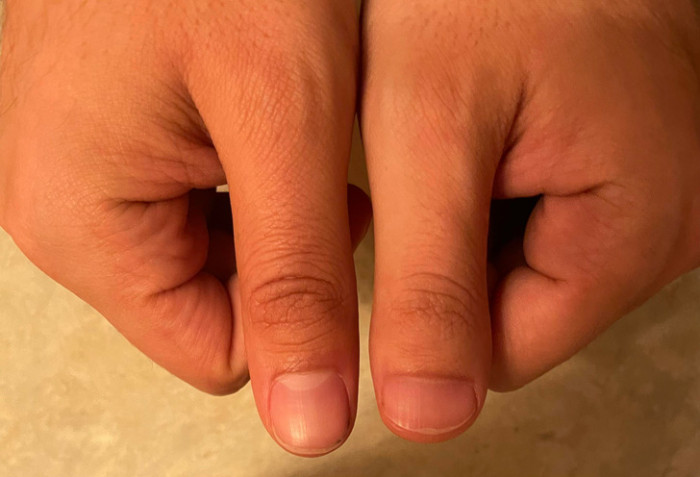 8. Different thumbs? Here is one very scientific explanation: This person sucked on one of them while going to sleep as a child :)