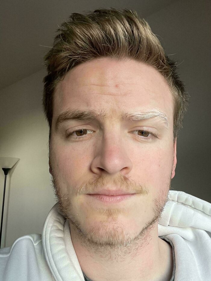 "My Left Eyebrow Is Suddenly Turning White"