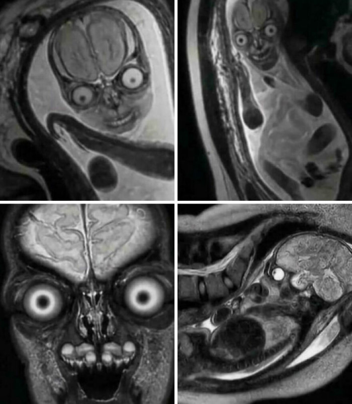 "Fetuses Look Like Aliens"