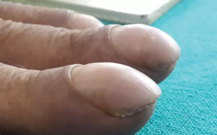 Close-up of fingernail showing subtle abnormal changes associated with early lung cancer