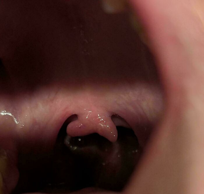 "I Have A Double Uvula"