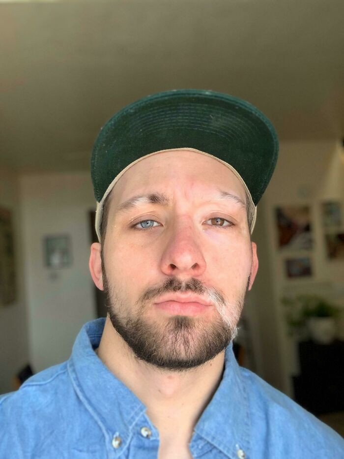 "I Have Vitiligo And Heterochromia"