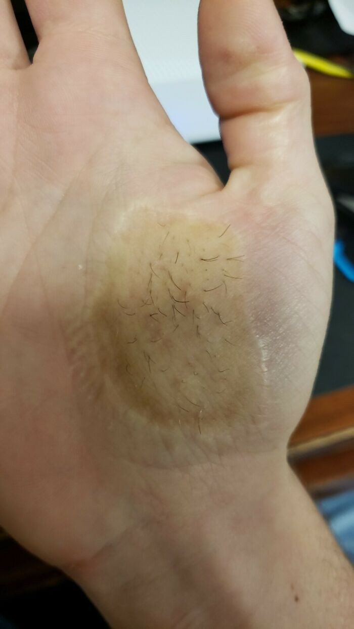 "The Palm Of My Hand Grows Hair After A Skin Graft I Received A Few Years Ago"