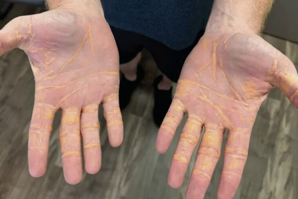 He was diagnosed with xanthelasma after his cholesterol shot past 25.9 mmol/L.