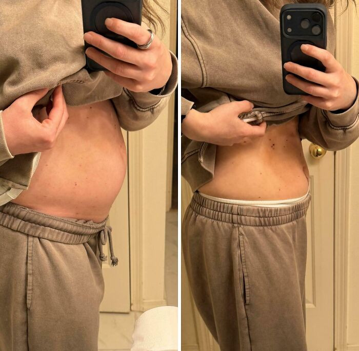 "Before And After Of Ovarian Cyst Removal"