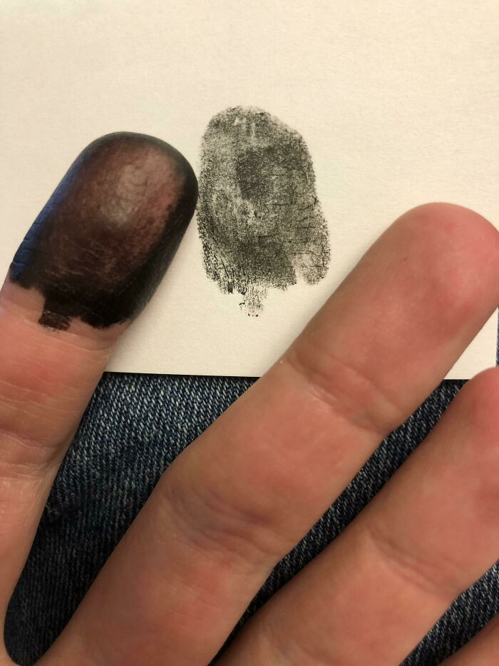 "I Was Born Without Finger Or Toe Prints"