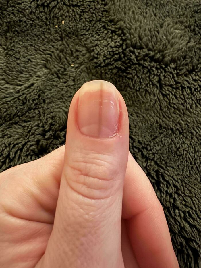 "A Dark Tan Line Showed Up On My Thumb Nail, And It Won’t Go Away"