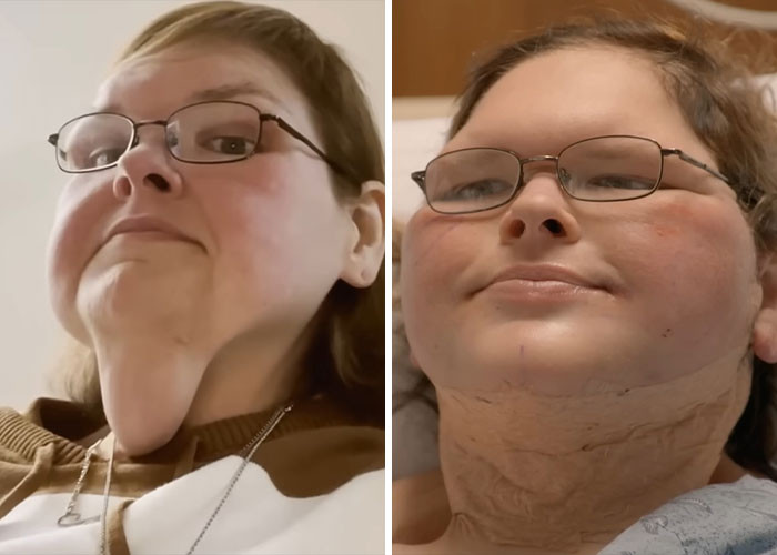 Tammy Slaton - Excess skin removal