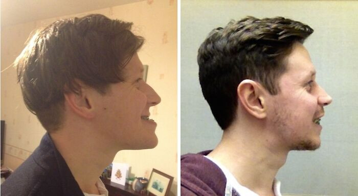 "Before & After Double Jaw Surgery"