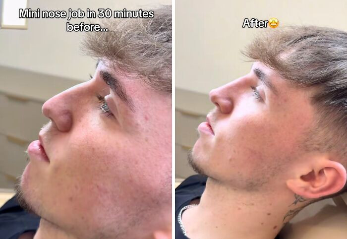 16. Mini nose job.