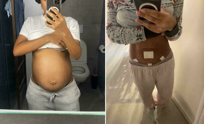 "Before & After Removing My 8 Kg Ovarian Cyst"