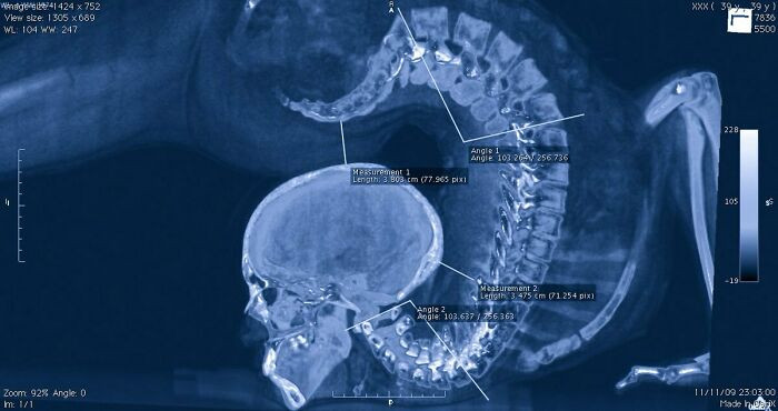"This Is An X-Ray Of A Contortionist Where It's Noticeable That A Significant Part Of The Spine Does Not Bend"