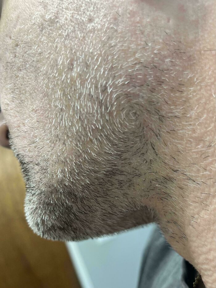 "The Swirl. My Facial Hair Grows In A Circular Pattern At The Back Of My Jawline"