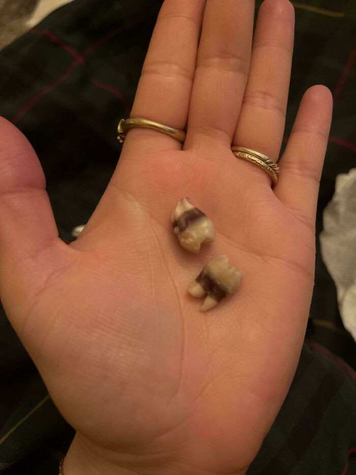 "My Wisdom Teeth Are"