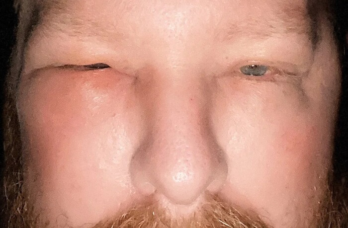 9. Poison oak and an upcoming presentation? Here’s a bee sting and a job interview in 4 hours!