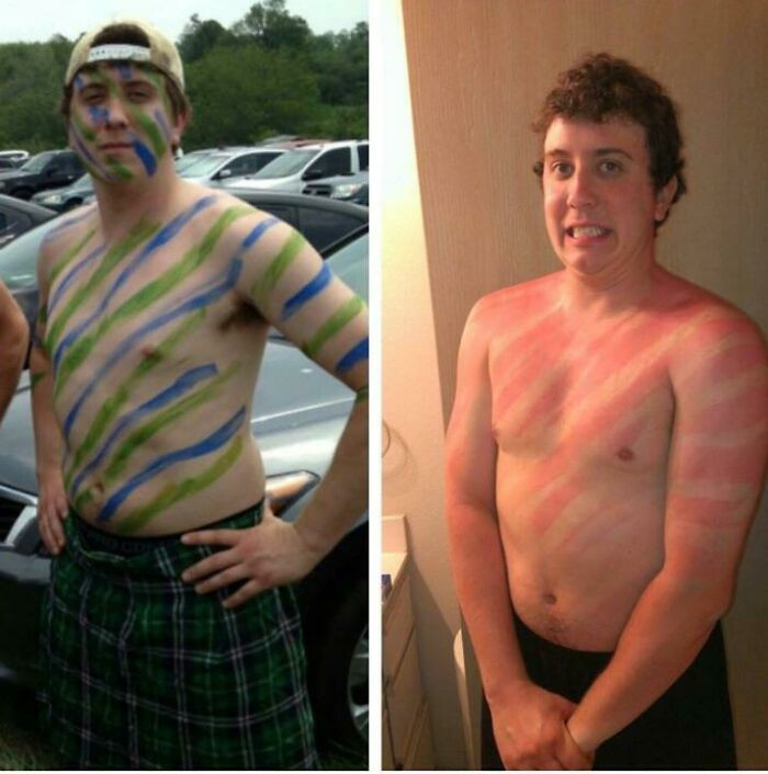 "Someone Forgot His Sunscreen"