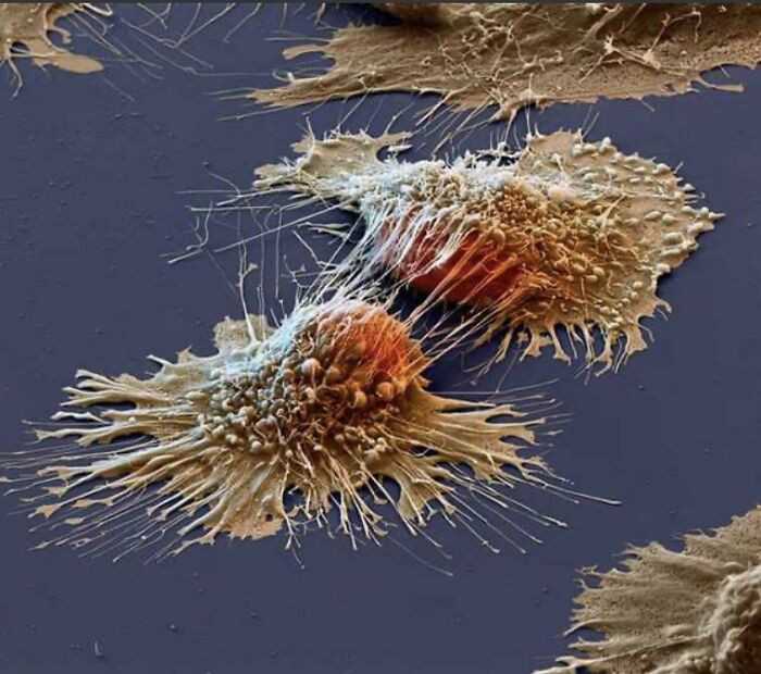 "Cancer Cells Under An Electron Microscope"