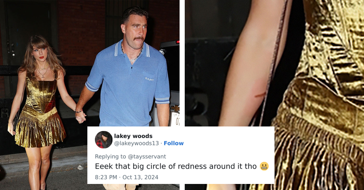 Fans Sound The Alarm After Spotting Concerning Injury On Taylor Swift’s Arm During A Date Night With Travis Kelce