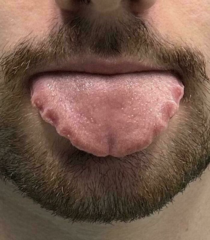 "The Shape Of My Tongue Due To Wearing Retainers At Night"