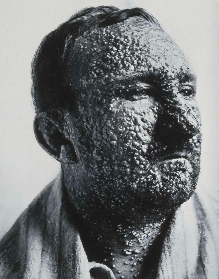 "Man With Small Pox, C 1900"