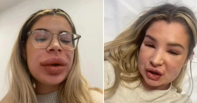 Lip Filler Nightmare - Woman, 24, Left Struggling to Breathe with 'Balloon Face and No Eyes' After Dissolution Procedure