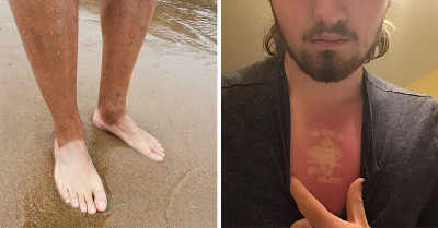 People Share 50 Of The Most Hilarious And Painful-looking Sunburns After Thinking They Don't Need Sunscreen