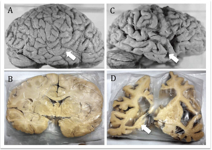 17. Neuroanatomical Comparison Of Normal Brain And Alzheimer’s Disease Brain