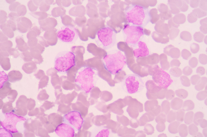 The leukemia cure turned out to be a double-edged sword.