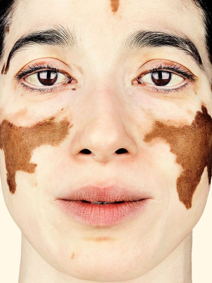 “Padmine Gajadhar” - Vitiligo