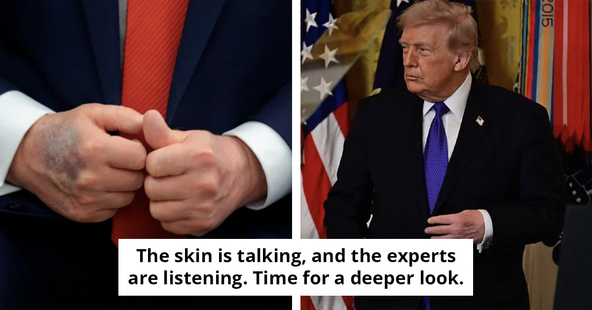 Donald Trump Raises New Health Concerns with Rash on Neck