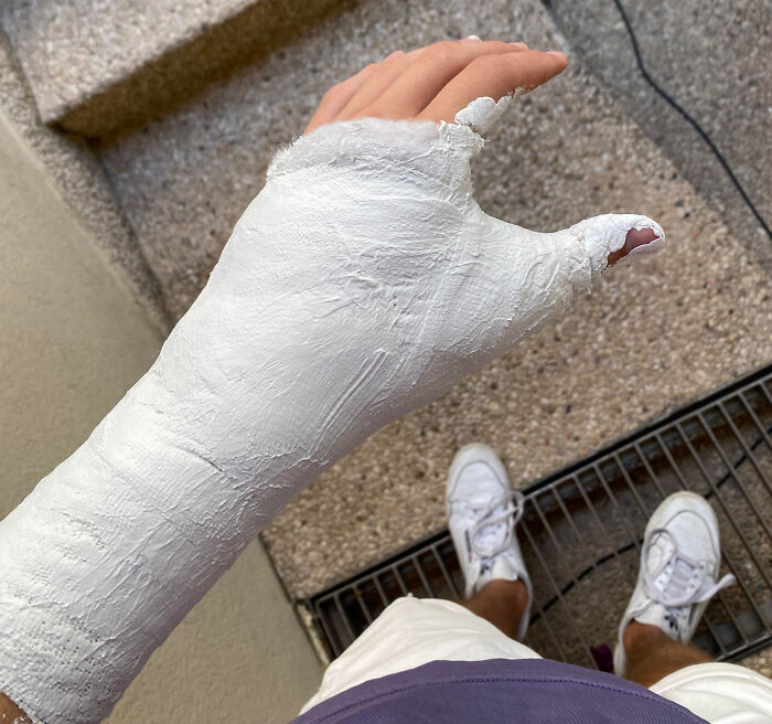 21. In a moment of drunken horseplay, my husband accidentally broke my thumb