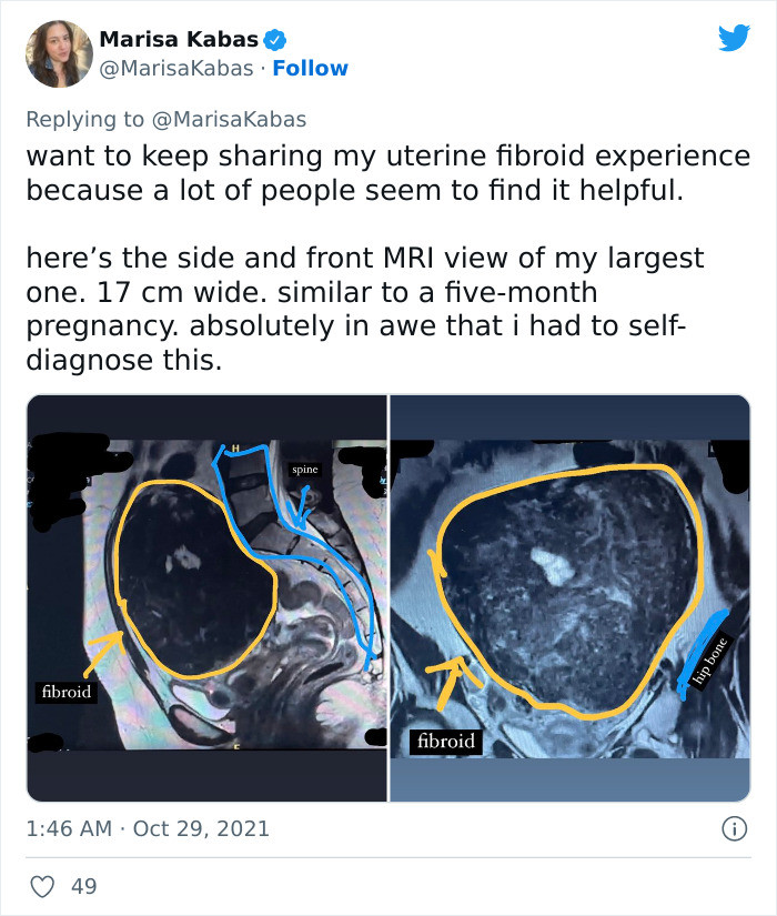 I'm sharing my uterine fibroid experience