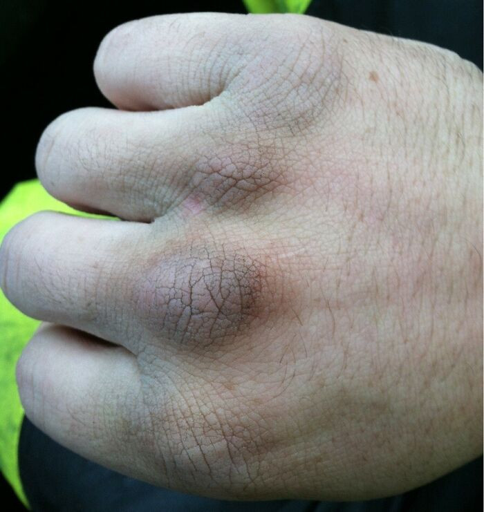 8. Be Nice To Your Trash Man When It's Raining And It's 30 Degrees Outside. We Are Not Invincible. This Is My Hand After Working 4 Hours In That Weather