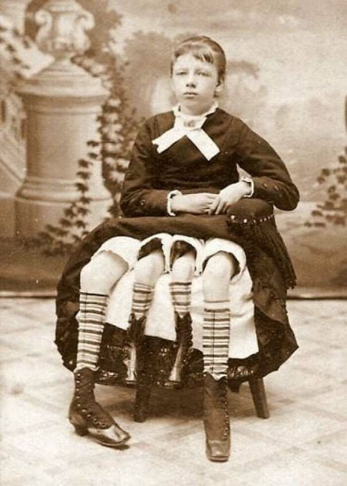 "Myrtle Corbin, Born 1868 In Tennessee. She Had Four Legs And Two Pelvises But Was Healthy"