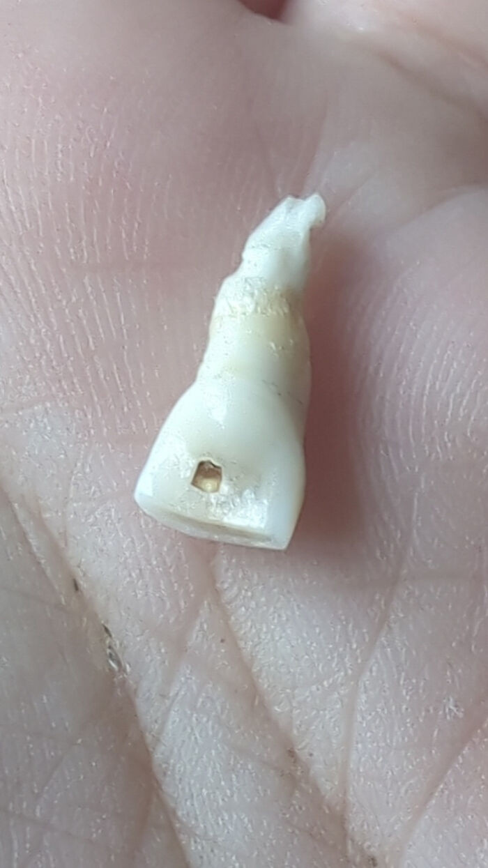 "My Son's Tooth Had A Nerve Growing Out The Back Of It"
