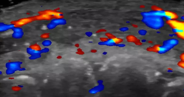 An ultrasound of a patient's lip reveals a section of an artery with no blood flow