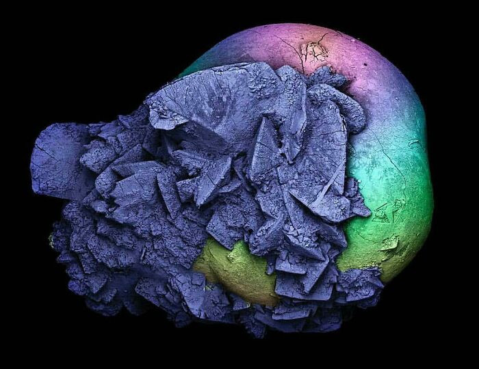 "Kidney Stones Under A Microscope. Size 2 Mm"